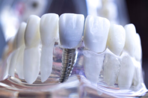 dental implants cost pyrmont
